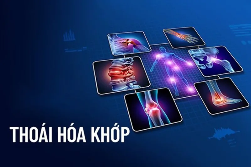 Bệnh viện Sante - Thoái hóa khớp Bệnh viện Sante - Thoái hóa khớp