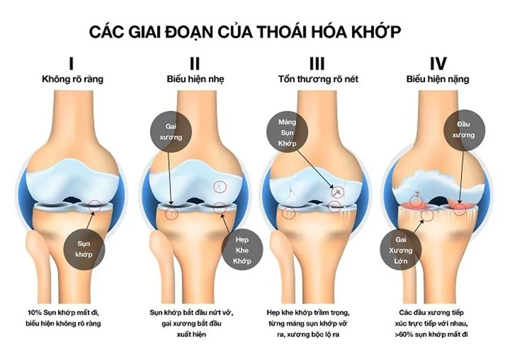 Bệnh viện Sante - Thoái hóa khớp Bệnh viện Sante - Thoái hóa khớp