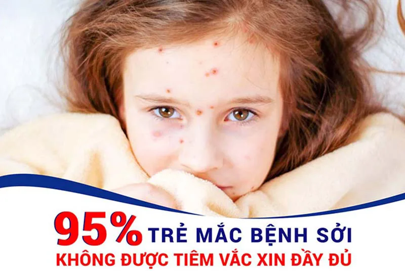 BỆNH SỞI NGUYÊN NHÂN, TRIỆU CHỨNG VÀ BIỆN PHÁP PHÒNG NGỪA - Hình 2 - Bệnh viện SANTE Bình Thạnh, TP.HCM BỆNH SỞI NGUYÊN NHÂN, TRIỆU CHỨNG VÀ BIỆN PHÁP PHÒNG NGỪA - Hình 2 - Bệnh viện SANTE Bình Thạnh, TP.HCM