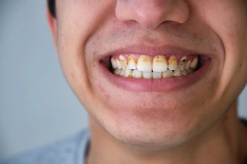 Bệnh viện Sante - Veneer sứ (mặt dán sứ) (Hình 4) Bệnh viện Sante - Veneer sứ (mặt dán sứ) (Hình 4)