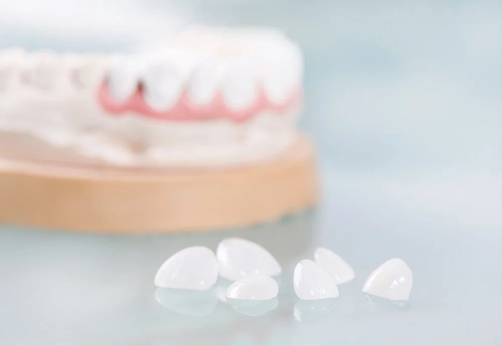 Bệnh viện Sante - Veneer sứ (mặt dán sứ) (Hình 2) Bệnh viện Sante - Veneer sứ (mặt dán sứ) (Hình 2)