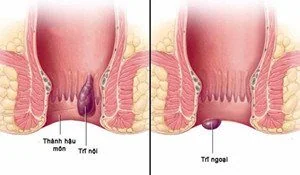 Bệnh viện Sante - Bệnh Trĩ Bệnh viện Sante - Bệnh Trĩ