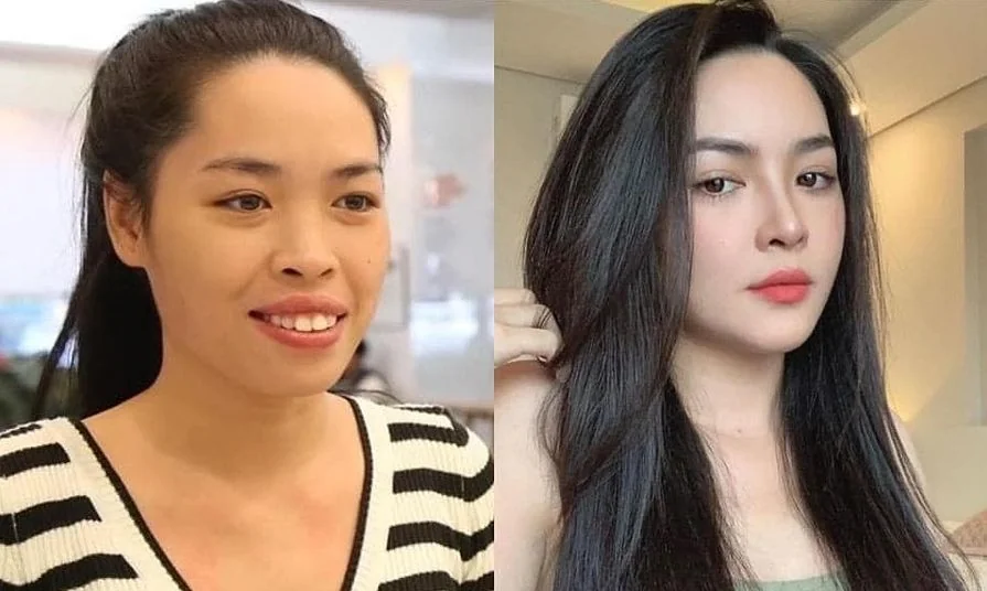 Bệnh viện Sante - Phẫu thuật thẩm mỹ thay đổi hoàn toàn gương mặt (Hình 4) Bệnh viện Sante - Phẫu thuật thẩm mỹ thay đổi hoàn toàn gương mặt (Hình 4)