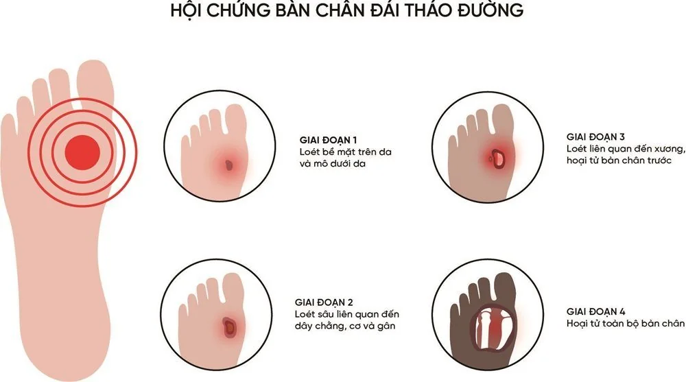 Bệnh viện Sante - Bệnh bàn chân đái tháo đường (Hình 2) Bệnh viện Sante - Bệnh bàn chân đái tháo đường (Hình 2)