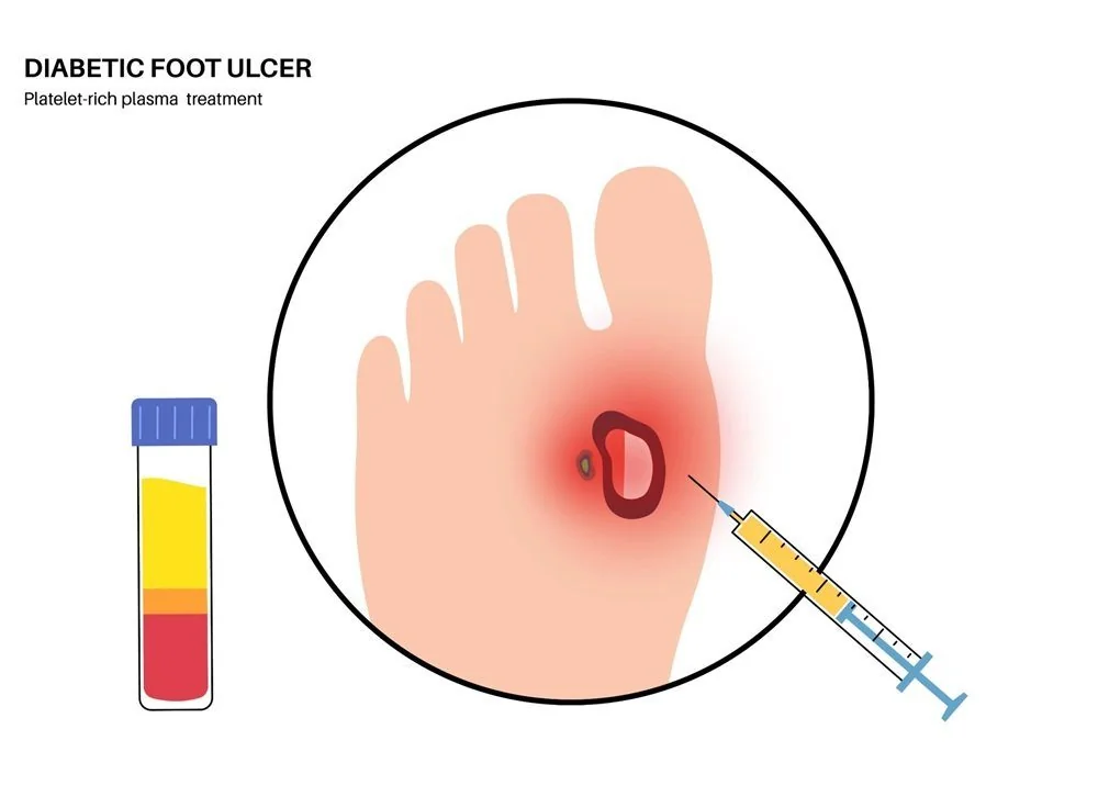 Bệnh viện Sante - Bệnh bàn chân đái tháo đường (Hình 3) Bệnh viện Sante - Bệnh bàn chân đái tháo đường (Hình 3)