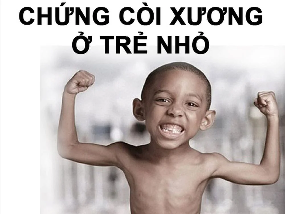 Bệnh viện Sante - Còi xương là bệnh như thế nào? Triệu chứng và cách chẩn đoán Bệnh viện Sante - Còi xương là bệnh như thế nào? Triệu chứng và cách chẩn đoán