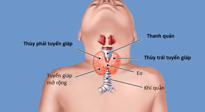 Bệnh viện Sante - Cường giáp là bệnh gì? Nguyên nhân_ dấu hiệu và cách chữa trị Bệnh viện Sante - Cường giáp là bệnh gì? Nguyên nhân_ dấu hiệu và cách chữa trị