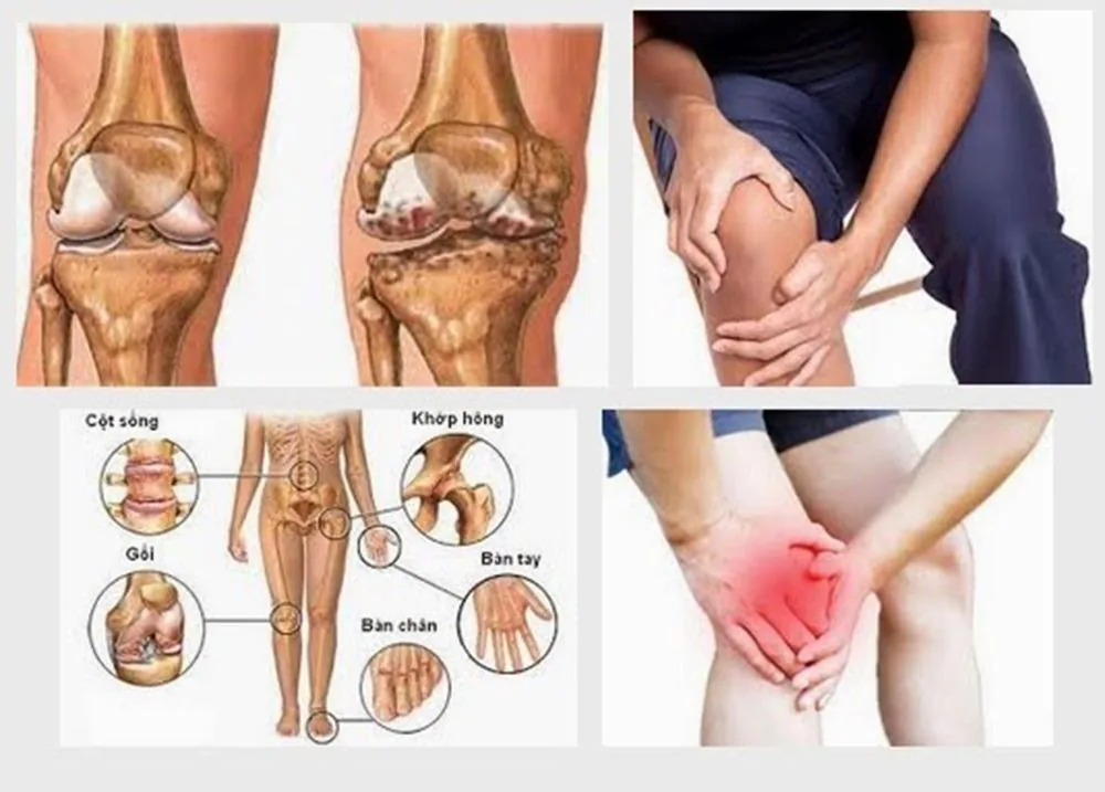 Bệnh viện Sante - Nguyên nhân bệnh đau khớp? Triệu chứng và cách chữa trị (Hình 3) Bệnh viện Sante - Nguyên nhân bệnh đau khớp? Triệu chứng và cách chữa trị (Hình 3)