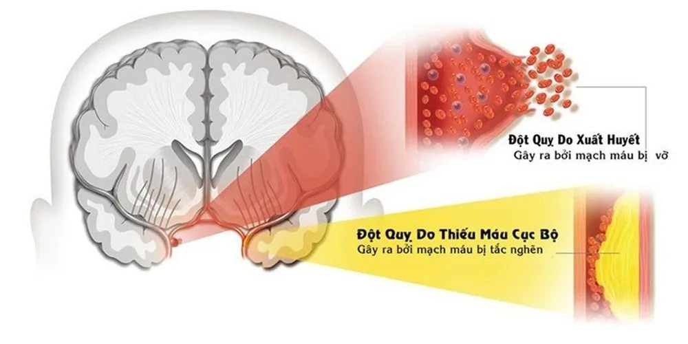 Đột quỵ và Stress: Những câu hỏi thường gặp - Hình 3 - Bệnh viện SANTE Bình Thạnh, TP.HCM Đột quỵ và Stress: Những câu hỏi thường gặp - Hình 3 - Bệnh viện SANTE Bình Thạnh, TP.HCM