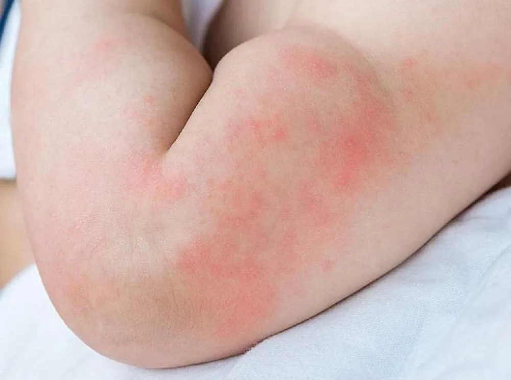 Bệnh viện Sante - Cách chăm sóc đúng tình trạng nổi mề đay ở trẻ nhỏ mẹ nên biết (Hình 2) Bệnh viện Sante - Cách chăm sóc đúng tình trạng nổi mề đay ở trẻ nhỏ mẹ nên biết (Hình 2)