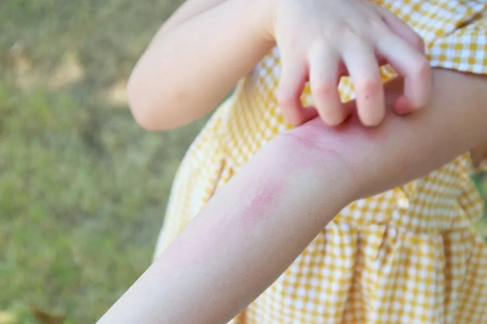 Bệnh viện Sante - Cách chăm sóc đúng tình trạng nổi mề đay ở trẻ nhỏ mẹ nên biết (Hình 4) Bệnh viện Sante - Cách chăm sóc đúng tình trạng nổi mề đay ở trẻ nhỏ mẹ nên biết (Hình 4)