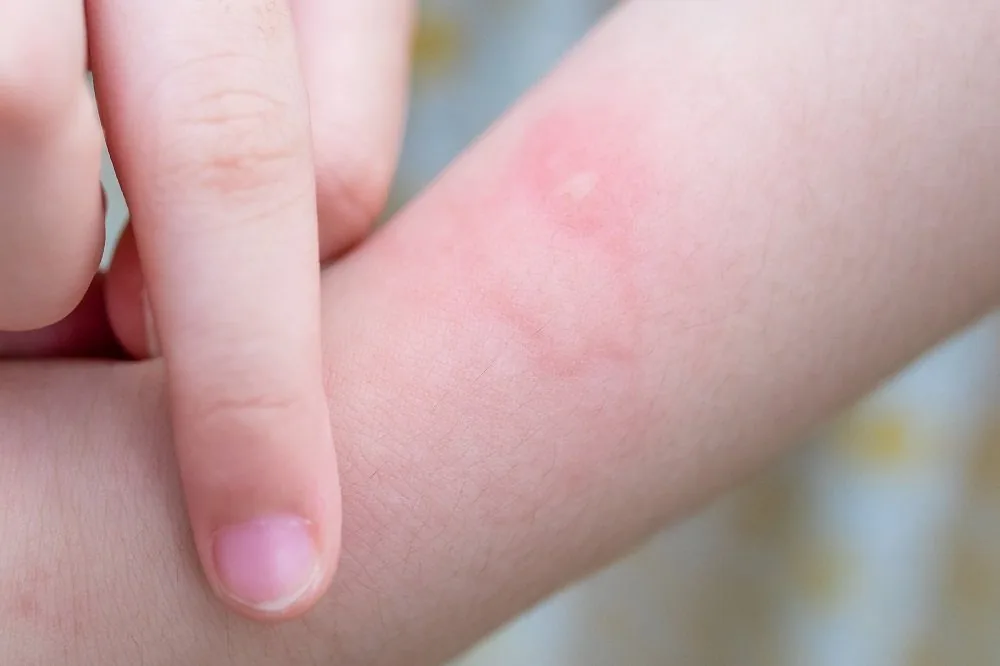 Bệnh viện Sante - Cách chăm sóc đúng tình trạng nổi mề đay ở trẻ nhỏ mẹ nên biết (Hình 3) Bệnh viện Sante - Cách chăm sóc đúng tình trạng nổi mề đay ở trẻ nhỏ mẹ nên biết (Hình 3)