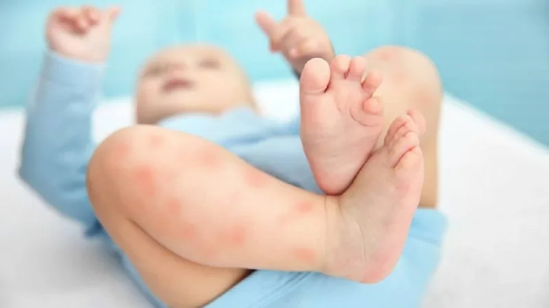 Bệnh viện Sante - Cách chăm sóc đúng tình trạng nổi mề đay ở trẻ nhỏ mẹ nên biết Bệnh viện Sante - Cách chăm sóc đúng tình trạng nổi mề đay ở trẻ nhỏ mẹ nên biết
