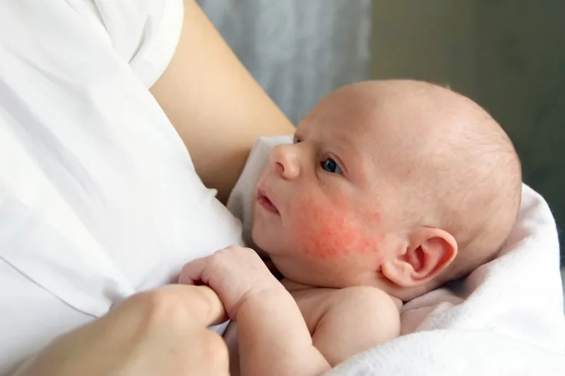 Bệnh viện Sante - Viêm da dị ứng ở trẻ: Nguyên nhân_ triệu chứng và cách điều trị Bệnh viện Sante - Viêm da dị ứng ở trẻ: Nguyên nhân_ triệu chứng và cách điều trị