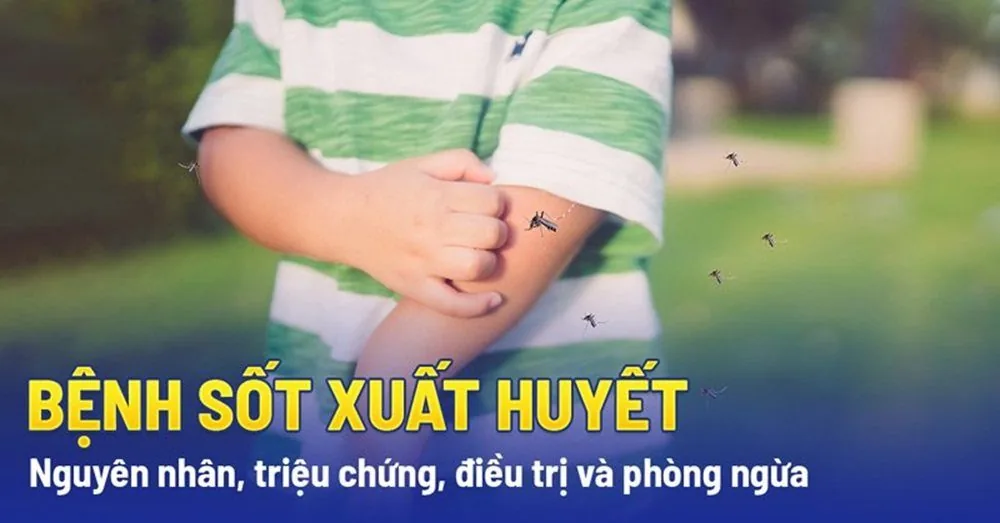 Bệnh viện Sante - Những điều cần biết về sốt xuất huyết (Hình 2) Bệnh viện Sante - Những điều cần biết về sốt xuất huyết (Hình 2)