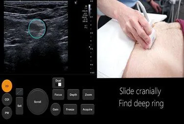 Bệnh viện Sante - Bệnh thoát vị bẹn (Hình 2) Bệnh viện Sante - Bệnh thoát vị bẹn (Hình 2)