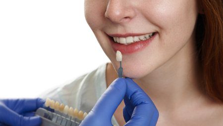 Veneer sứ (mặt dán sứ)