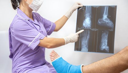 Nẹp cố định và bó bột các trường hợp gãy xương