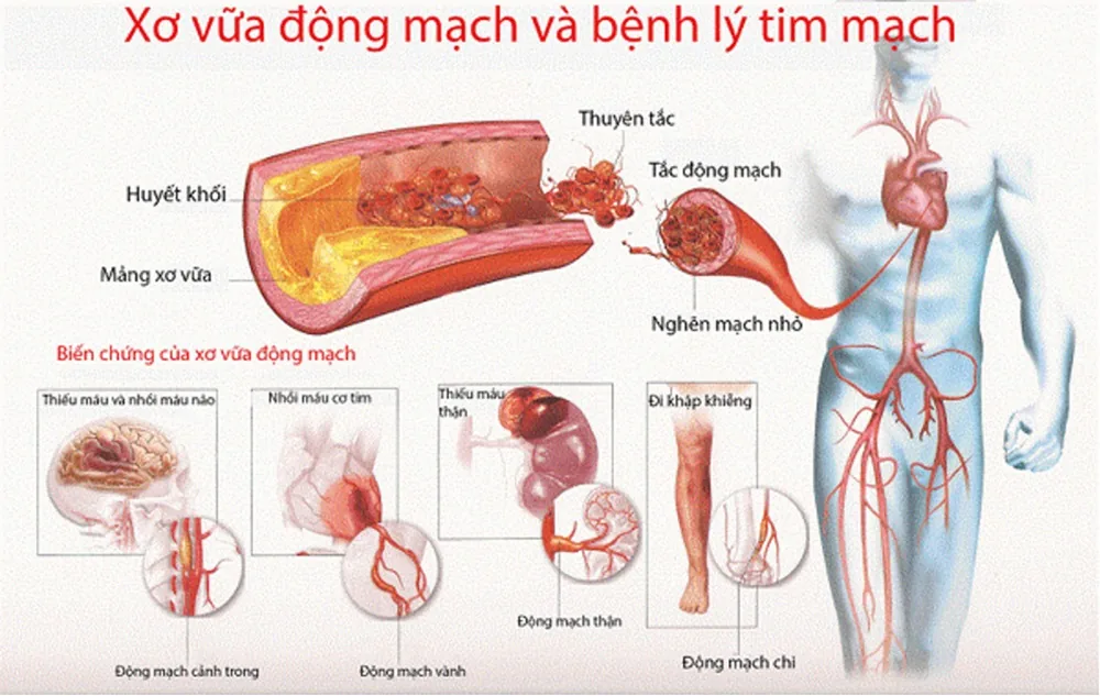 Rối loạn Lipid máu và nguy cơ bệnh tim mạch - Hình 2 - Bệnh viện SANTE Bình Thạnh, TP.HCM Rối loạn Lipid máu và nguy cơ bệnh tim mạch - Hình 2 - Bệnh viện SANTE Bình Thạnh, TP.HCM