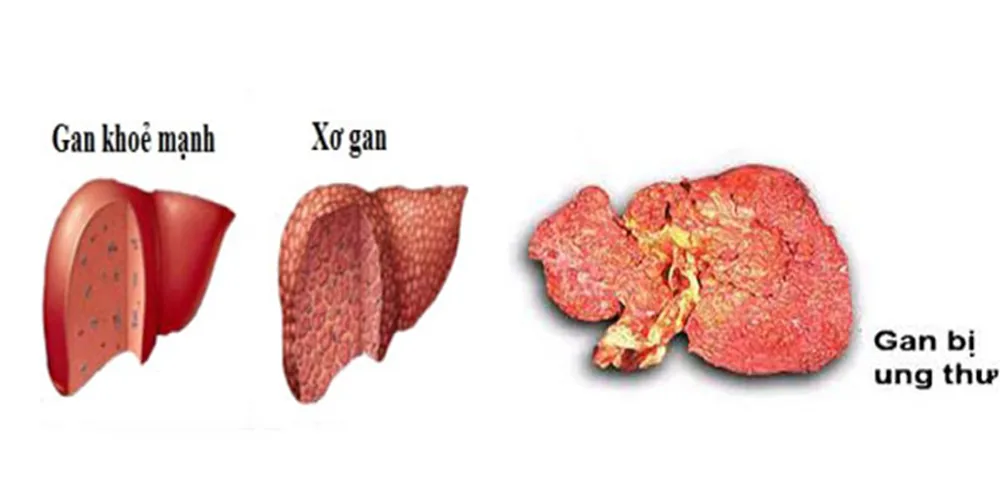 Dấu hiệu nhận biết xơ gan và ung thư gan 1 Dấu hiệu nhận biết xơ gan và ung thư gan 1 - Bệnh viện SANTE Bình Thạnh, TP.HCM
