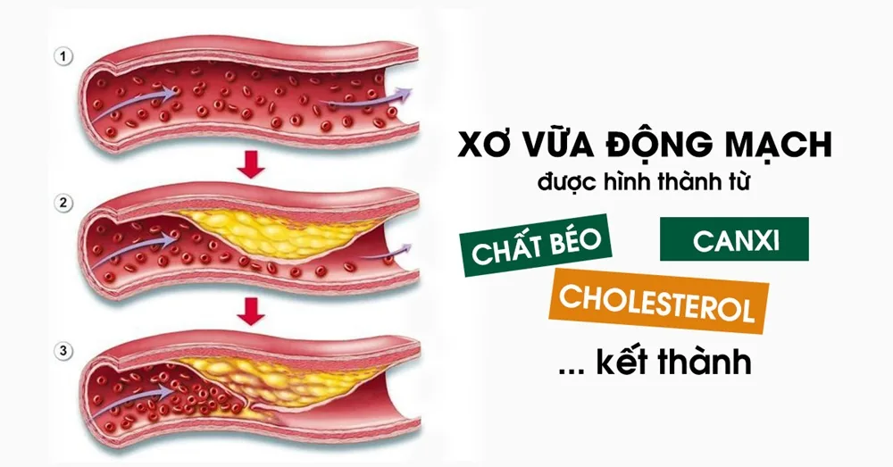 Xơ vữa động mạch - nguy cơ gây tử vong thầm lặng - Hình 2 - Bệnh viện SANTE Bình Thạnh, TP.HCM Xơ vữa động mạch - nguy cơ gây tử vong thầm lặng - Hình 2 - Bệnh viện SANTE Bình Thạnh, TP.HCM